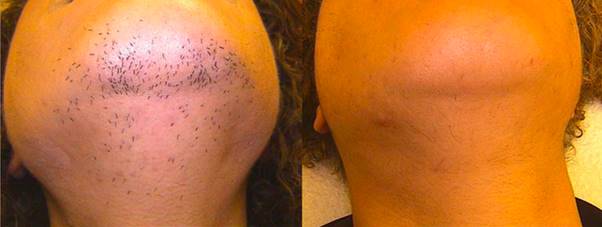 Hair Laser Removal | Face Treatments  Chelmsford gallery image 5