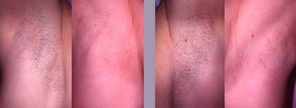 Hair Laser Removal | Face Treatments  Chelmsford gallery image 4