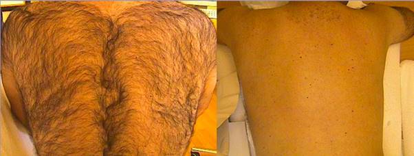 Hair Laser Removal | Face Treatments  Chelmsford gallery image 3